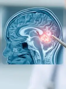 Brain Tumor Surgery in Panama City, Panama by Pacifica Salud