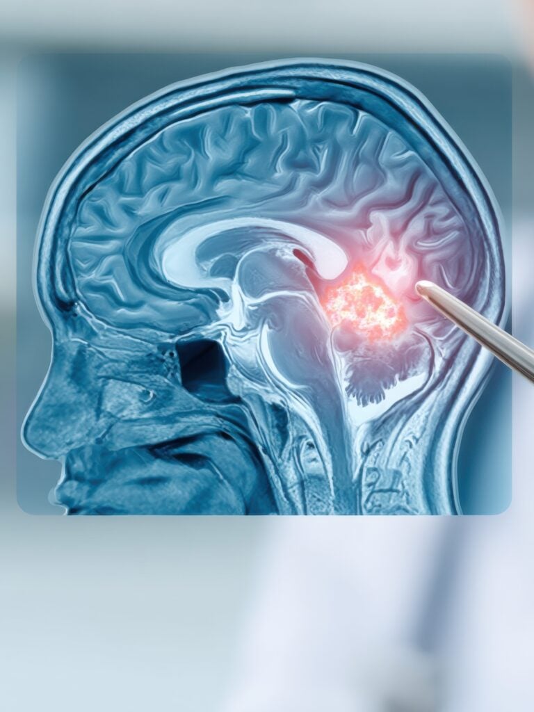 Brain Tumor Surgery in Panama City, Panama by Pacifica Salud — Oncology Procedure in Panama
