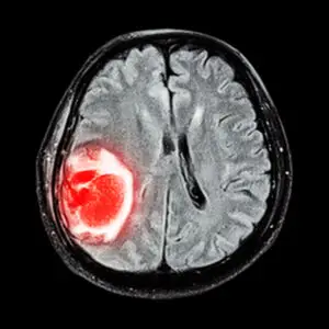 Brain Tumor Treatment Clinics and Procedures Abroad