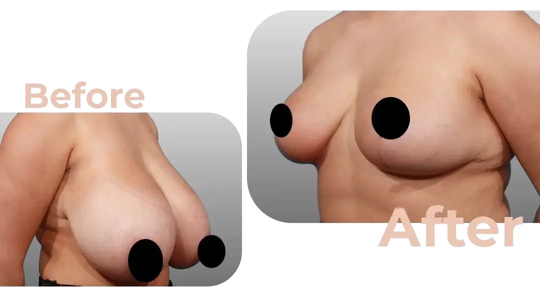 Breast Reduction Surgery in Istanbul, Turkey by Avicenna Hospital