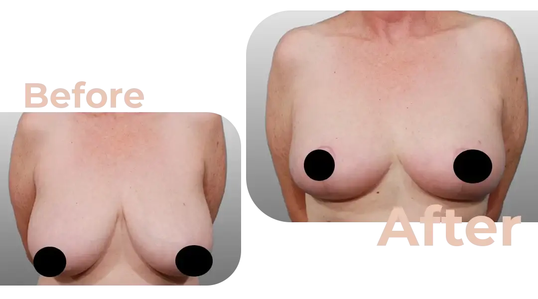 Breast Reduction Surgery in Istanbul, Turkey by Avicenna Hospital