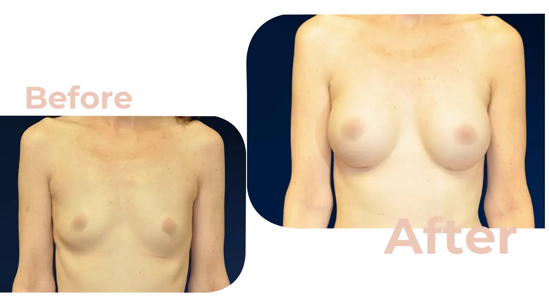Breast Augmentation Surgery in Istanbul, Turkey by Avicenna Hospital
