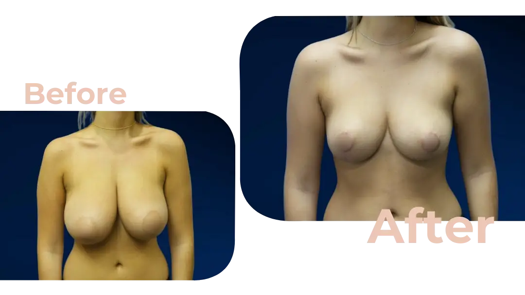 Breast Reduction Surgery in Istanbul, Turkey by Avicenna Hospital