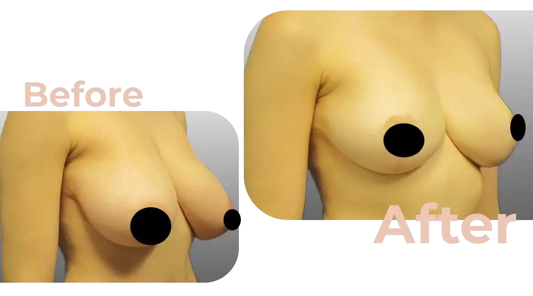 Breast Reduction Surgery in Istanbul, Turkey by Avicenna Hospital