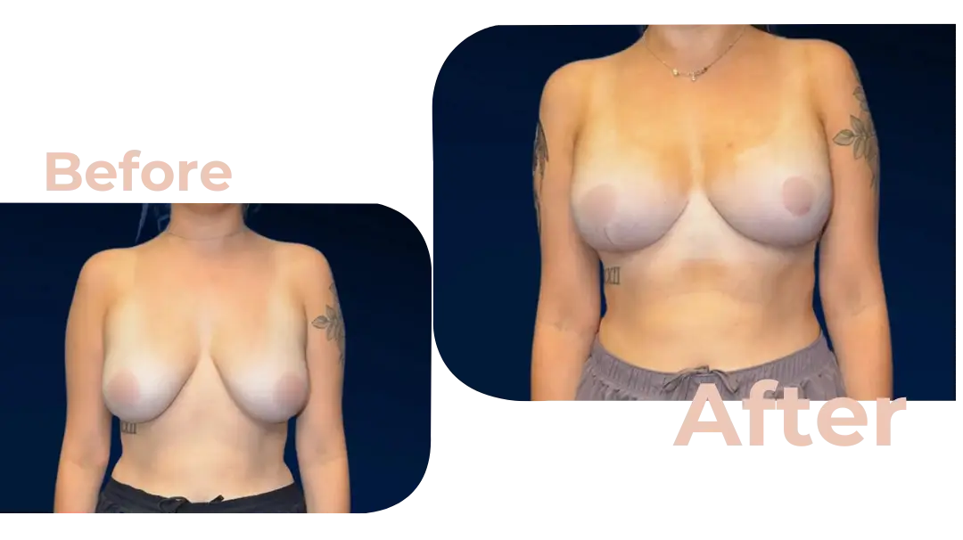 Breast Augmentation Surgery in Istanbul, Turkey by Avicenna Hospital