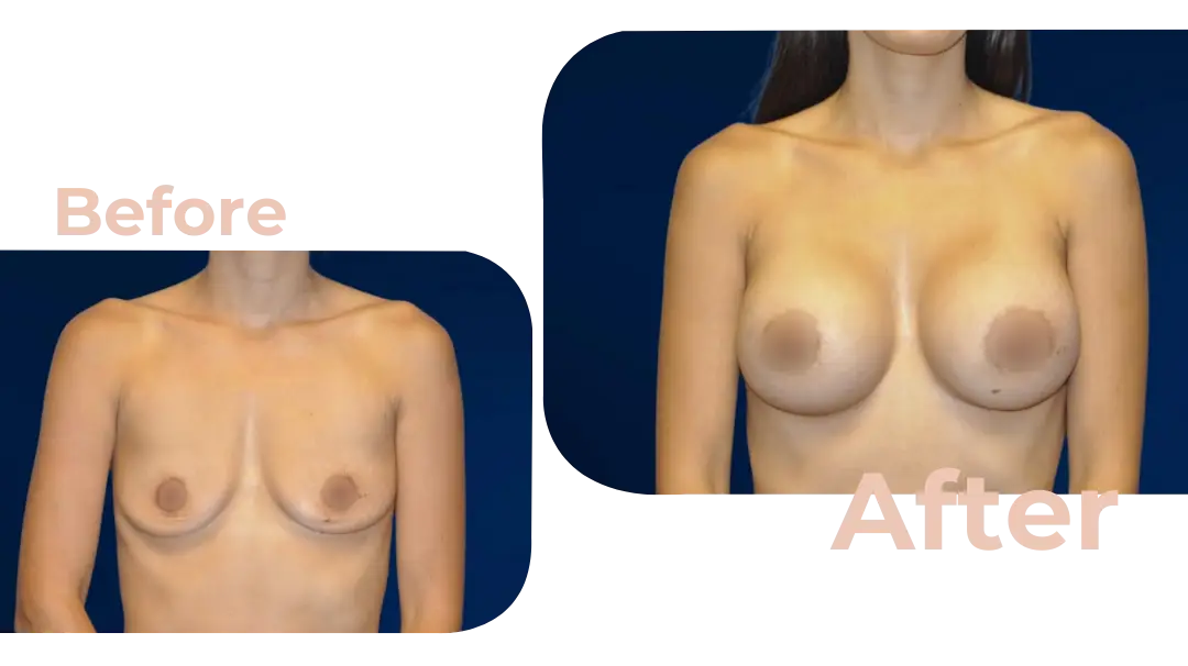 Breast Augmentation Surgery in Istanbul, Turkey by Avicenna Hospital