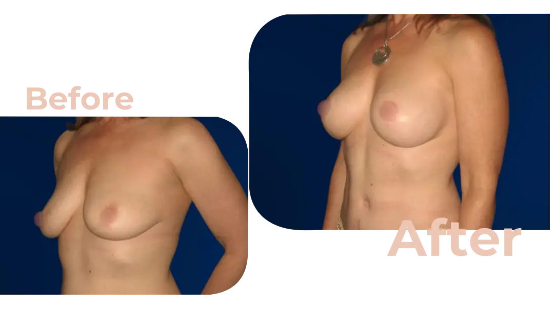 Breast Augmentation Surgery in Istanbul, Turkey by Avicenna Hospital