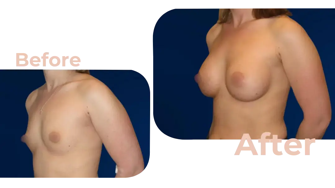 Breast Augmentation Surgery in Istanbul, Turkey by Avicenna Hospital