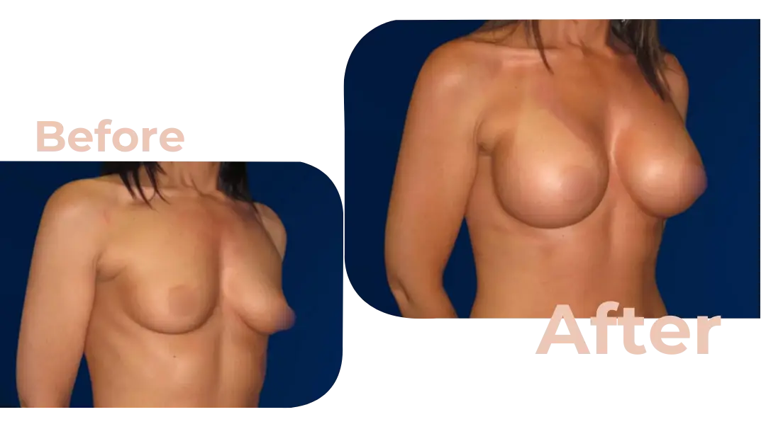 Breast Augmentation Surgery in Istanbul, Turkey by Avicenna Hospital