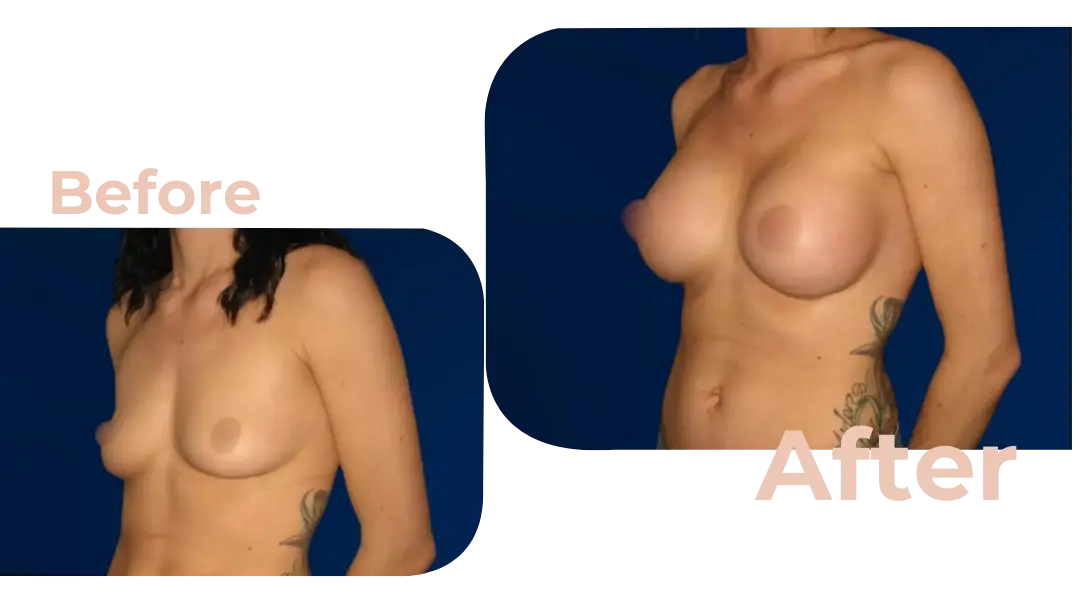 Breast Augmentation Surgery in Istanbul, Turkey by Avicenna Hospital