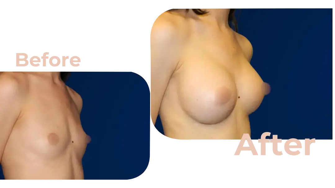 Breast Augmentation Surgery in Istanbul, Turkey by Avicenna Hospital