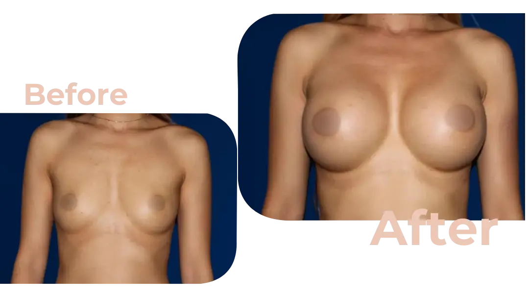 Breast Augmentation Surgery in Istanbul, Turkey by Avicenna Hospital