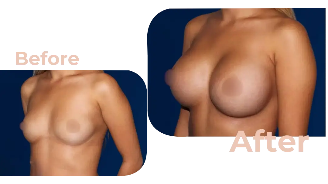 Breast Augmentation Surgery in Istanbul, Turkey by Avicenna Hospital