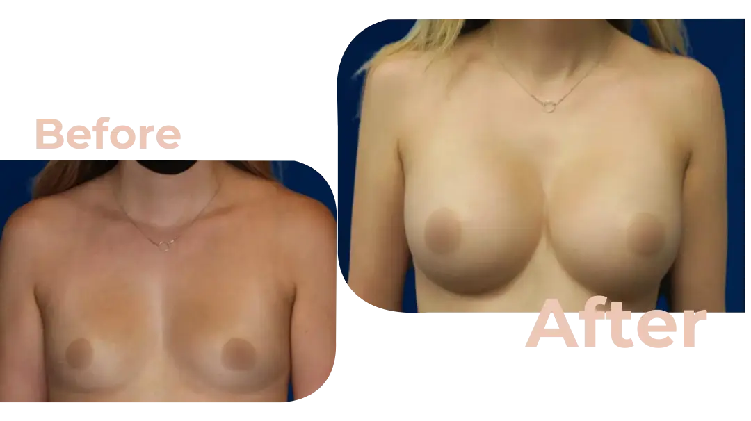 Breast Augmentation Surgery in Istanbul, Turkey by Avicenna Hospital