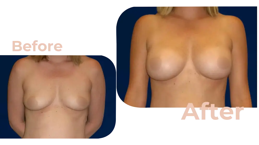 Breast Augmentation Surgery in Istanbul, Turkey by Avicenna Hospital