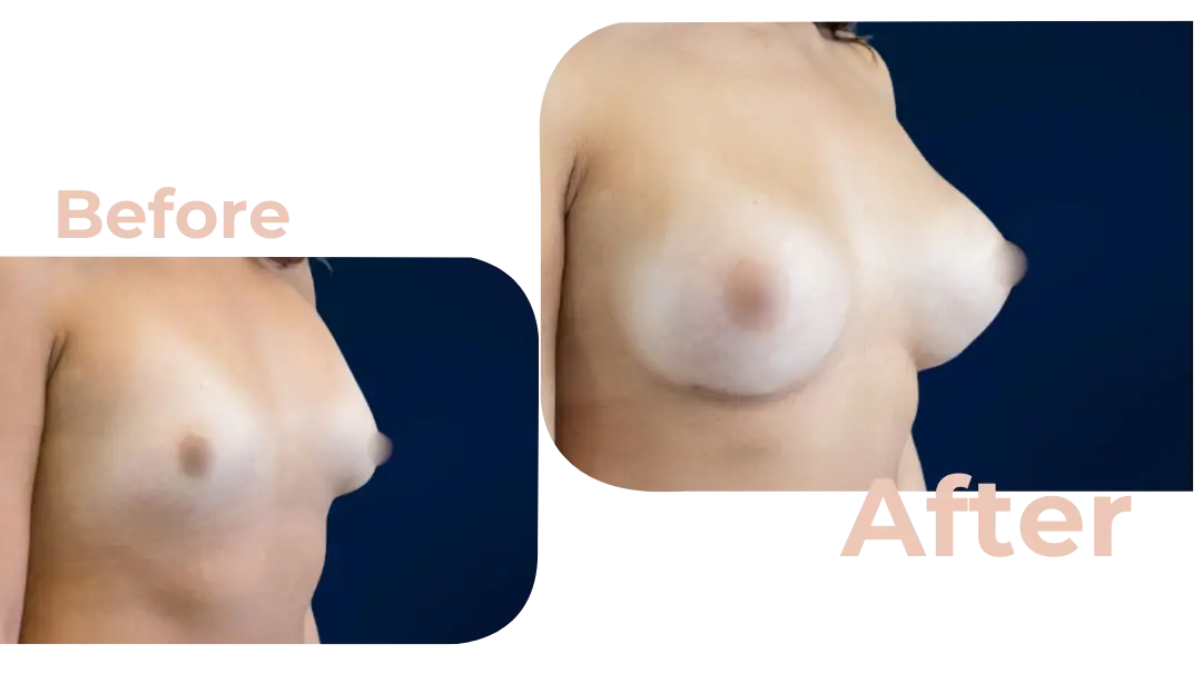 Breast Augmentation Surgery in Istanbul, Turkey by Avicenna Hospital
