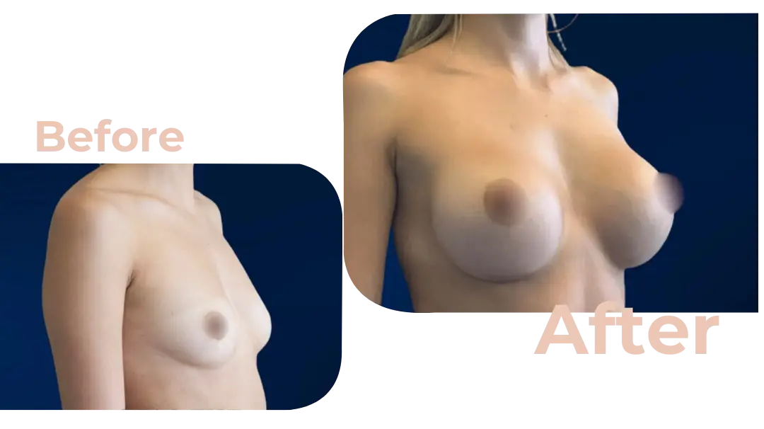 Breast Augmentation Surgery in Istanbul, Turkey by Avicenna Hospital