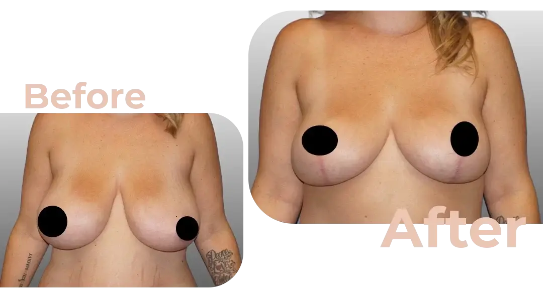 Breast Lift Surgery in Istanbul, Turkey by Avicenna Hospital