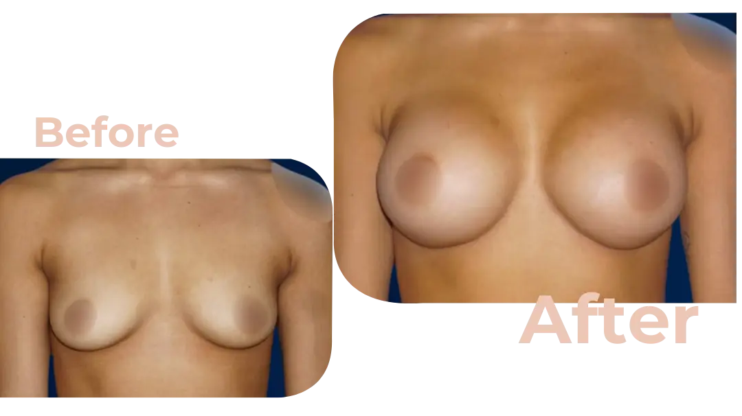 Breast Augmentation Surgery in Istanbul, Turkey by Avicenna Hospital