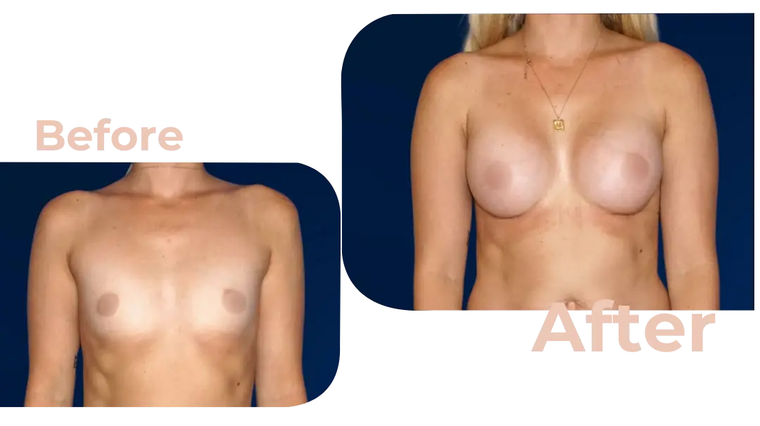 Breast Augmentation Surgery in Istanbul, Turkey by Avicenna Hospital