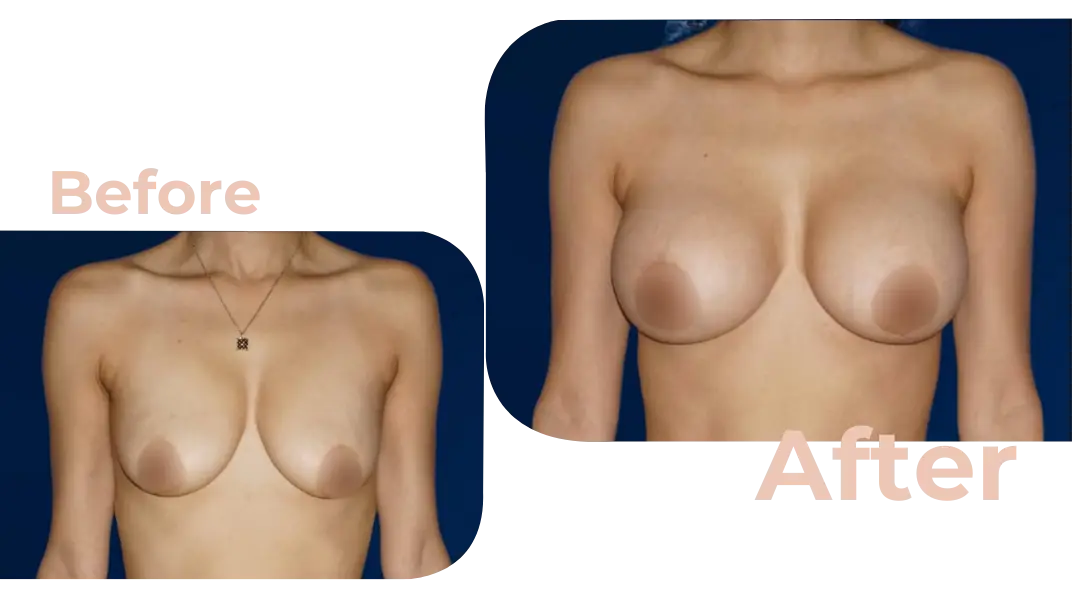 Breast Augmentation Surgery in Istanbul, Turkey by Avicenna Hospital