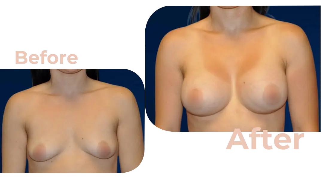 Breast Augmentation Surgery in Istanbul, Turkey by Avicenna Hospital
