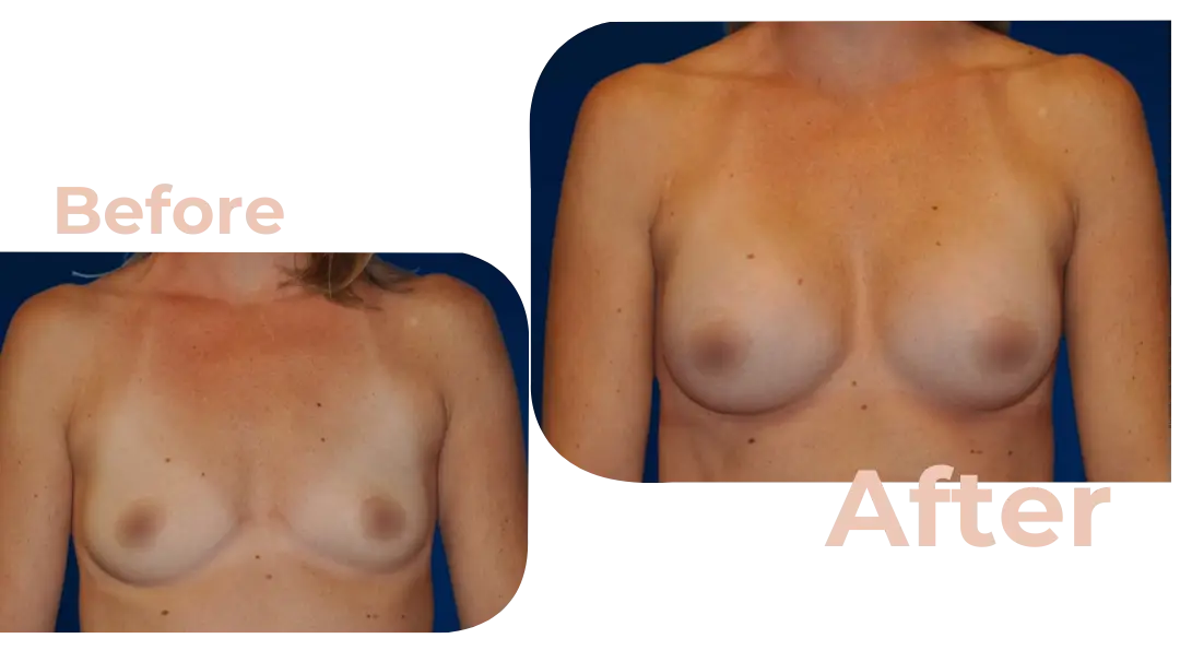 Breast Augmentation Surgery in Istanbul, Turkey by Avicenna Hospital