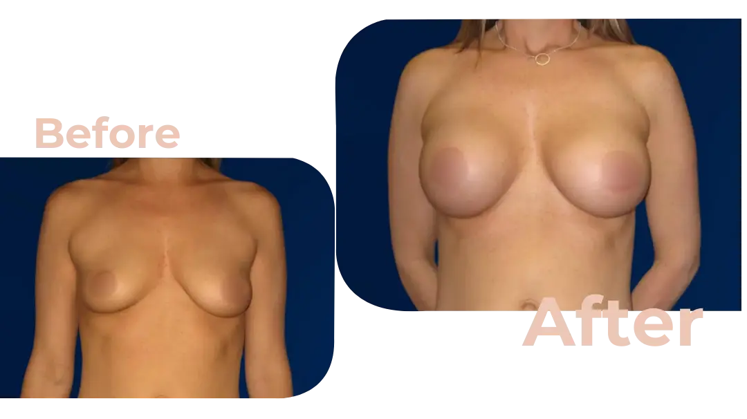 Breast Augmentation Surgery in Istanbul, Turkey by Avicenna Hospital