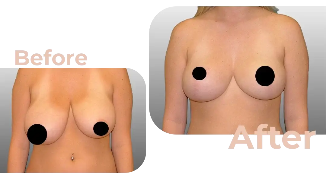 Breast Reduction Surgery in Istanbul, Turkey by Avicenna Hospital