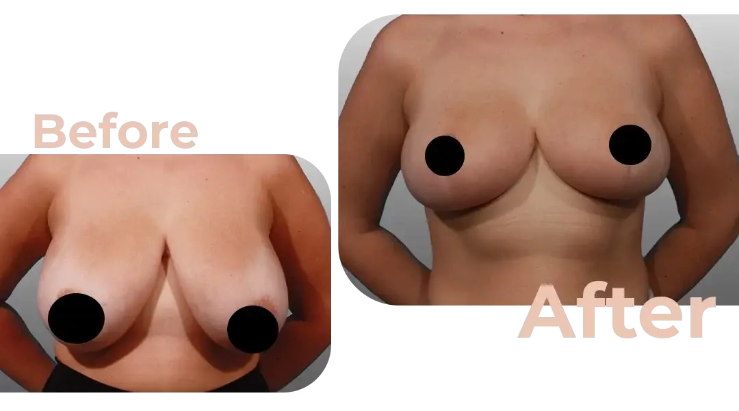 Breast Reduction Surgery in Istanbul, Turkey by Avicenna Hospital