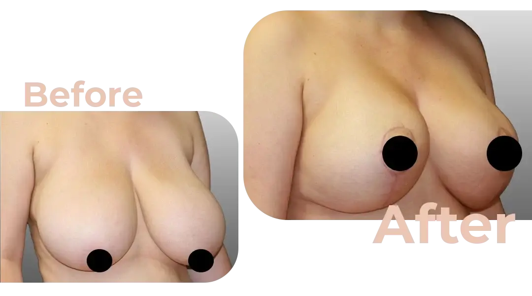 Breast Reduction Surgery in Istanbul, Turkey by Avicenna Hospital