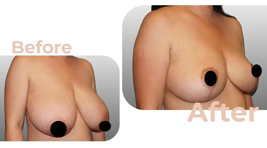 Breast Reduction Surgery in Istanbul, Turkey by Avicenna Hospital