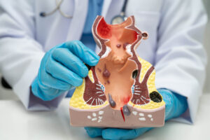 Hemorrhoid Treatment in São Paulo, Brazil by Kaiser Clínica at Kaiser Hospital Dia — Colorectal Surgery Procedure Abroad