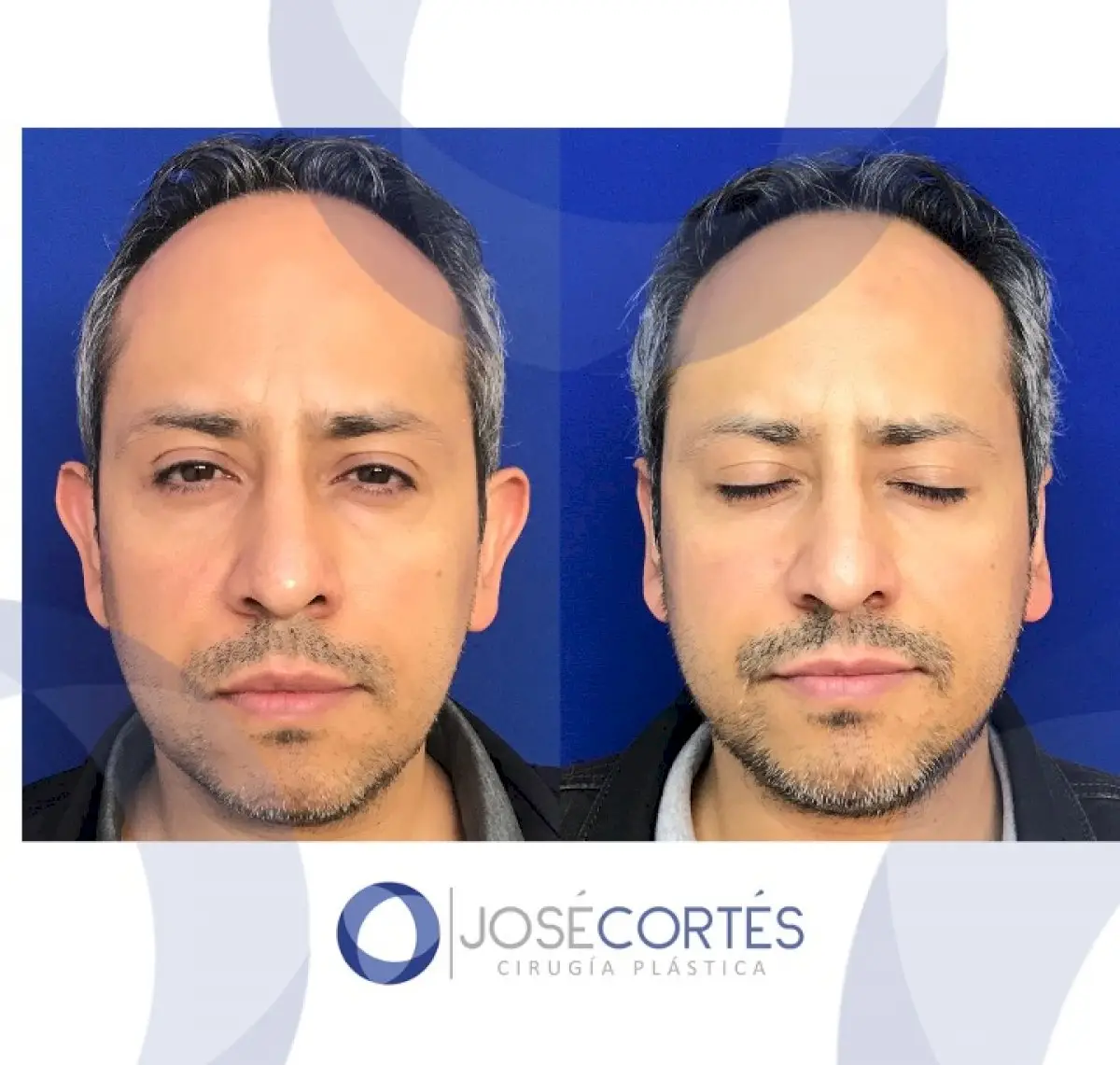 Otoplasty (Ear Surgery) in Mexico City, Mexico by Jose Cortes Institute