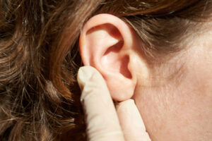 Otoplasty (Ear Surgery) in Mexico City, Mexico by Jose Cortes Institute — Plastic Surgery in Mexico
