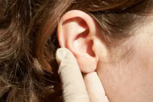 Otoplasty (Ear Surgery) in Mexico City, Mexico by Jose Cortes Institute