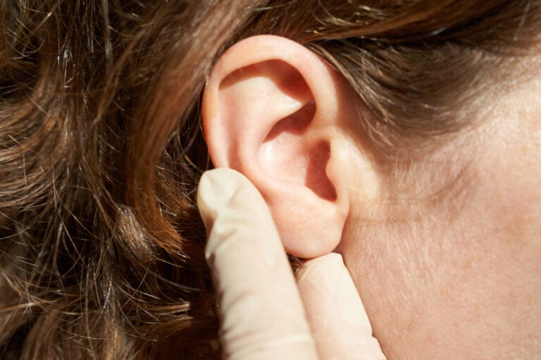 Otoplasty (Ear Surgery) in Mexico City, Mexico by Jose Cortes Institute
