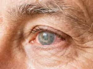 Cataract Surgery in Istanbul, Turkey by Avicenna Hospital — Ophthalmology in Turkey
