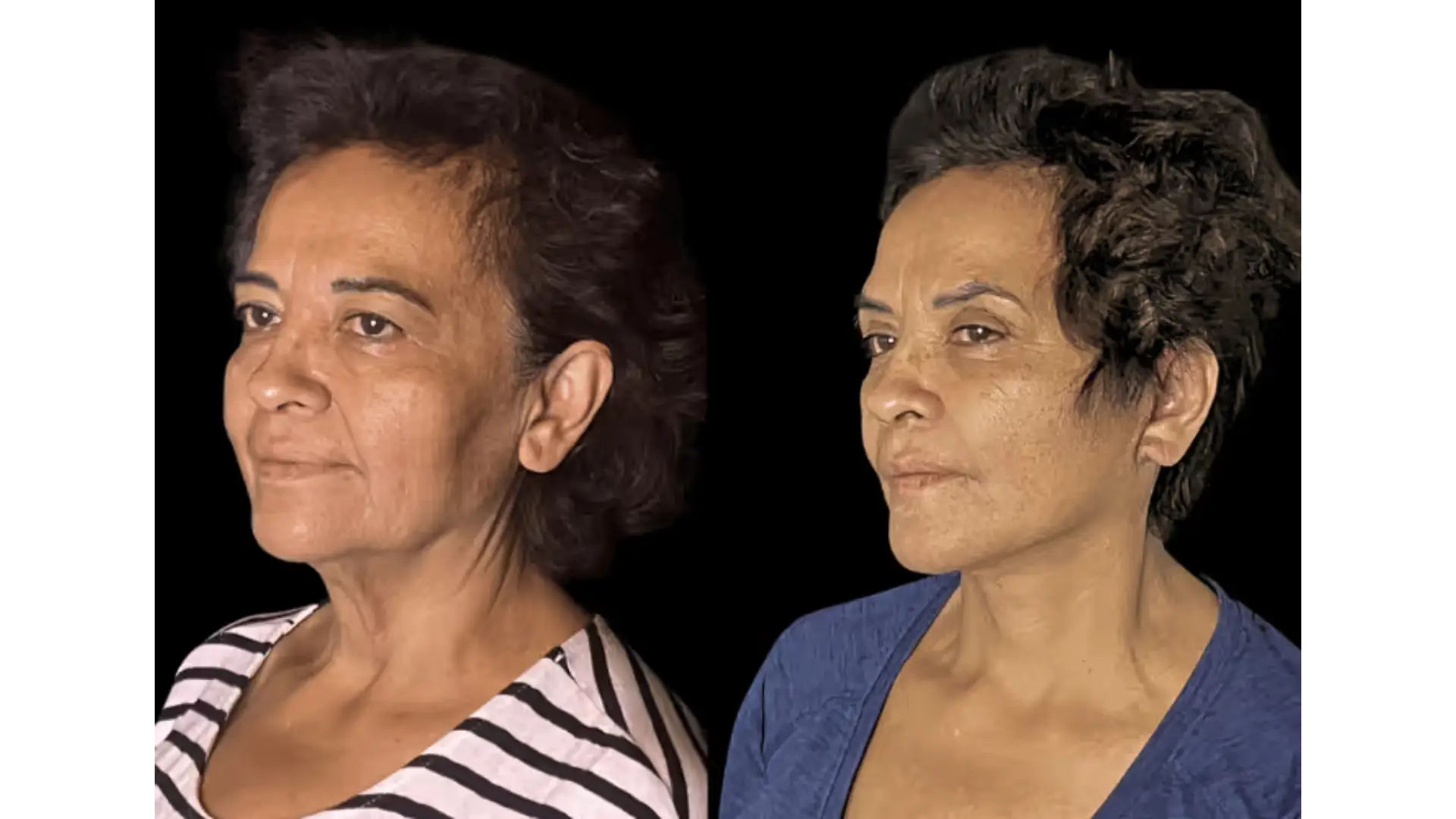 Deep Plane Facelift in Mexico City, Mexico by Jose Cortes Institute — Procedure Gallery Photo