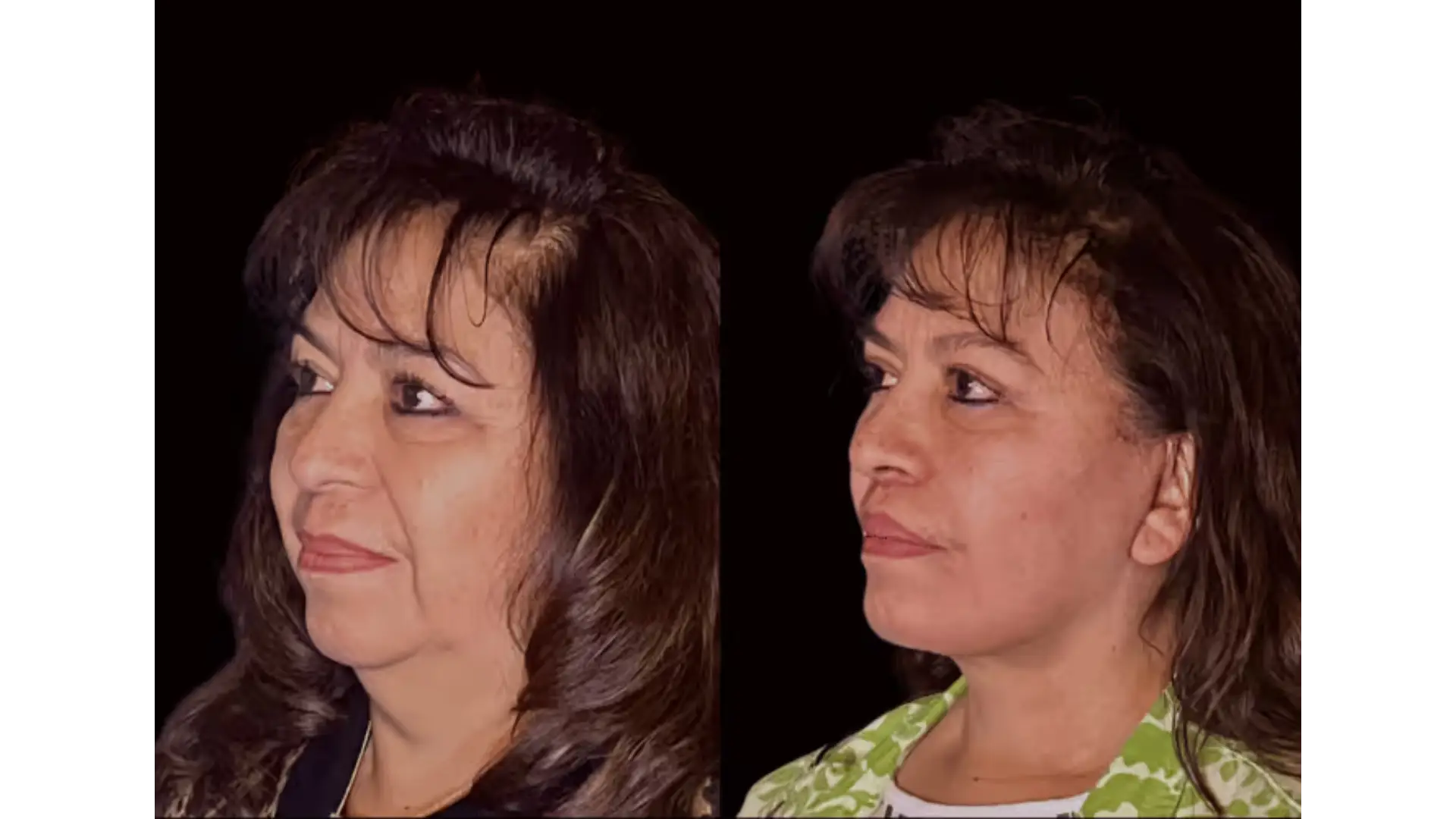 Deep Plane Facelift in Mexico City, Mexico by Jose Cortes Institute — Procedure Gallery Photo