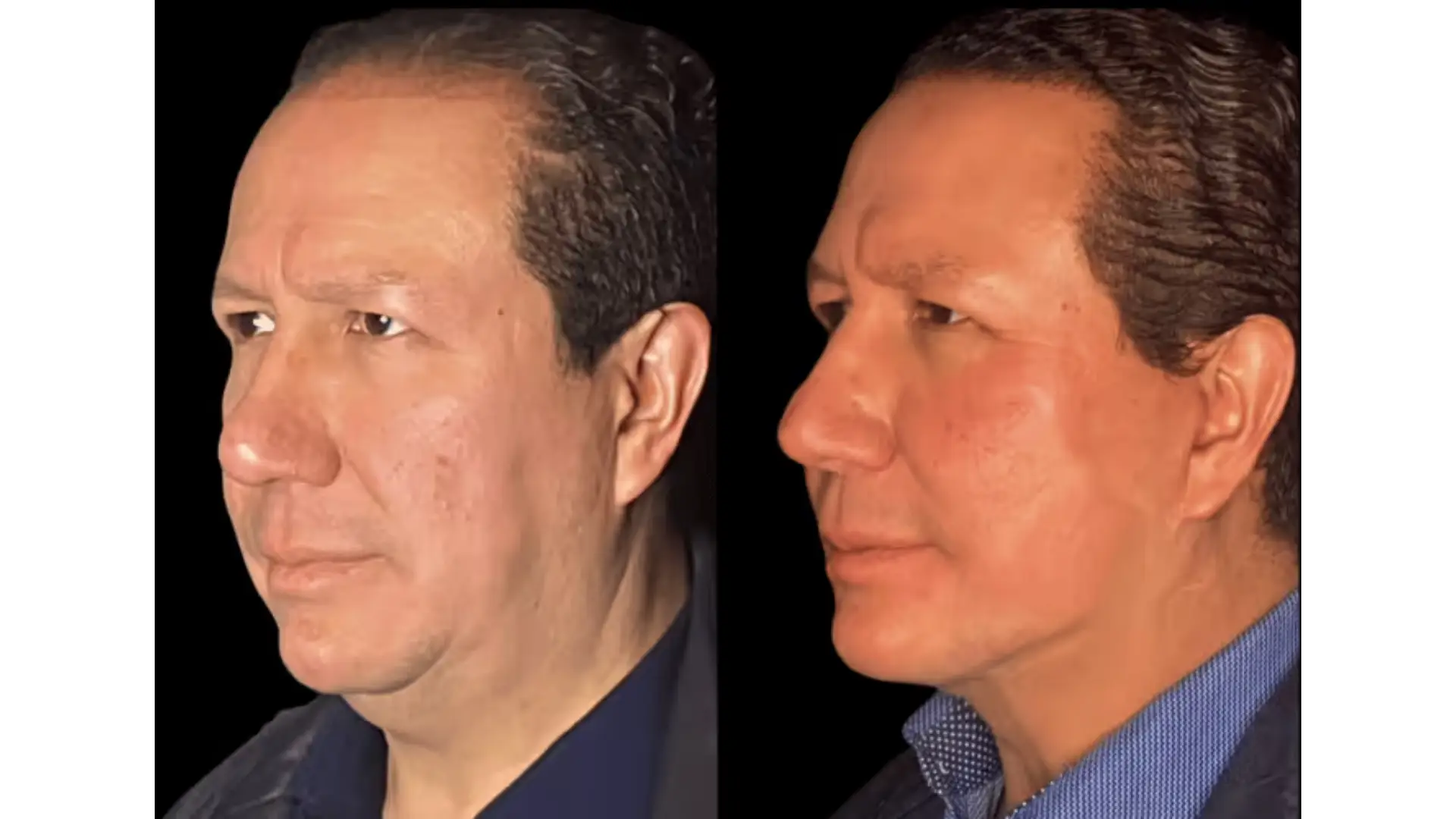 Deep Plane Facelift in Mexico City, Mexico by Jose Cortes Institute — Procedure Gallery Photo