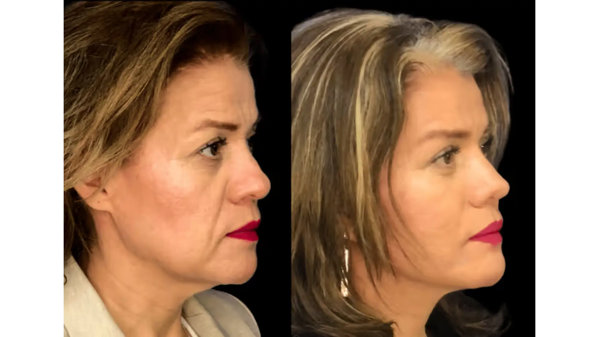 Deep Plane Facelift in Mexico City, Mexico by Jose Cortes Institute — Procedure Gallery Photo