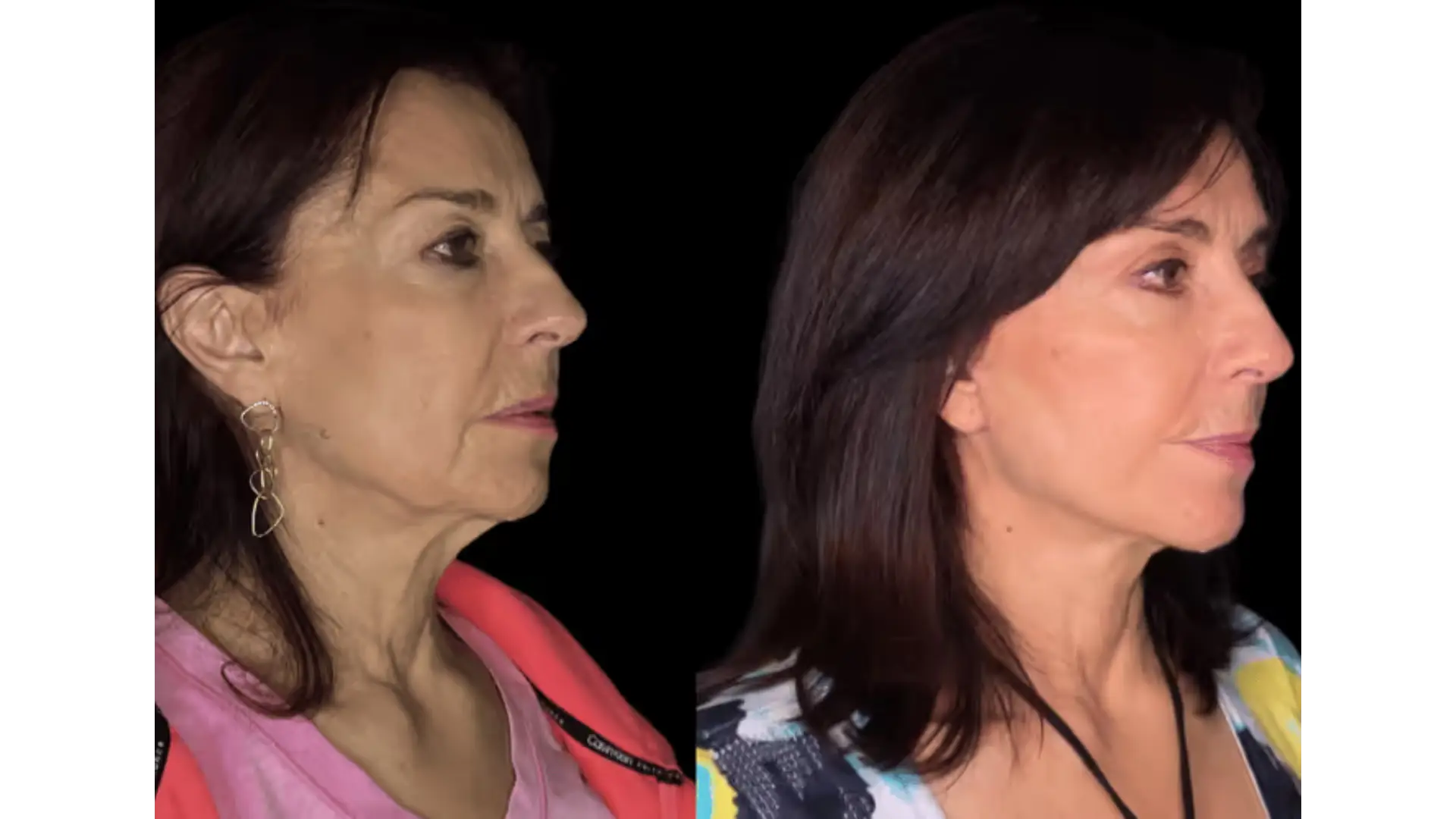 Deep Plane Facelift in Mexico City, Mexico by Jose Cortes Institute — Procedure Gallery Photo