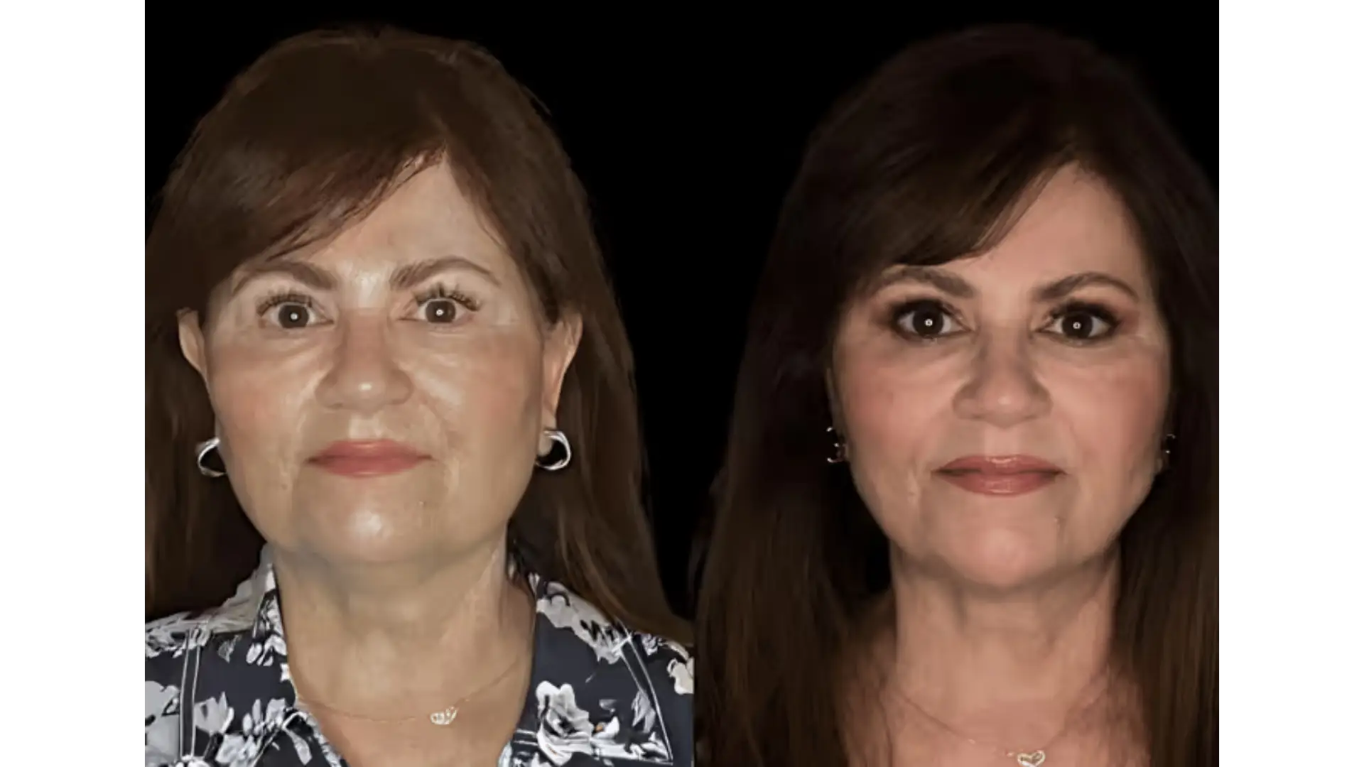 Deep Plane Facelift in Mexico City, Mexico by Jose Cortes Institute — Procedure Gallery Photo