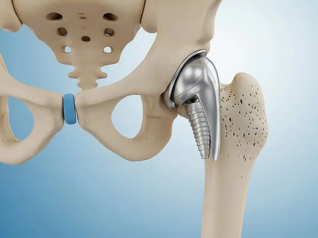 Total Hip Replacement in Panama City, Panama by Pacifica Salud — Orthopedics Procedure in Panama