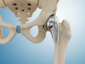 Total Hip Replacement in Panama City, Panama by Pacifica Salud — Orthopedics in Panama