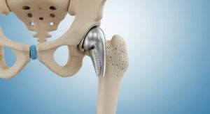 Total Hip Replacement in Panama City, Panama by Pacifica Salud at Pacifica Salud — Orthopedics Procedure Abroad