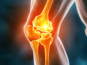 Total Knee Replacement in Panama City, Panama by Pacifica Salud at Pacifica Salud — Orthopedics Procedure Abroad