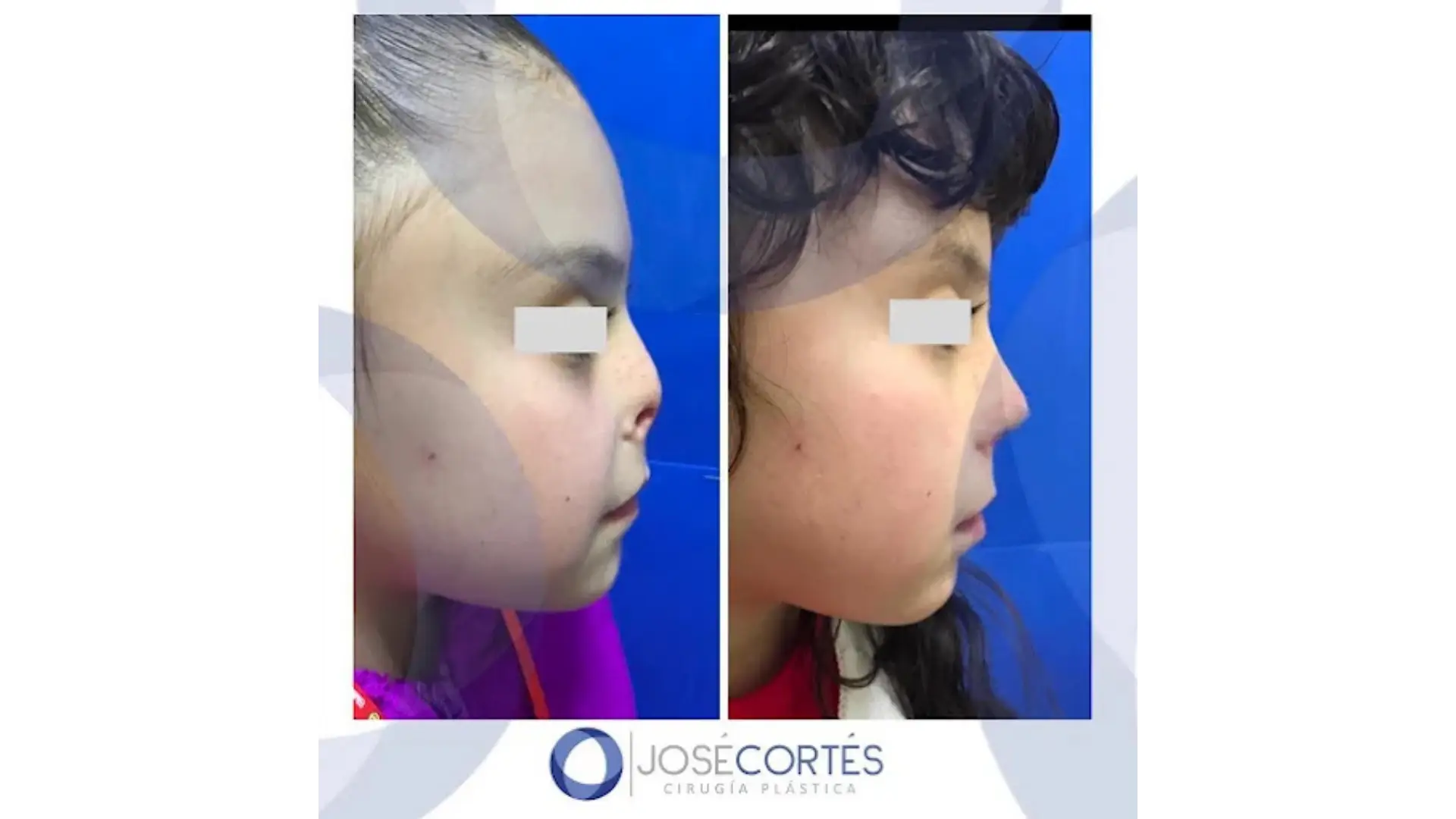 Rhinoplasty in Mexico City, Mexico by Jose Cortes Institute