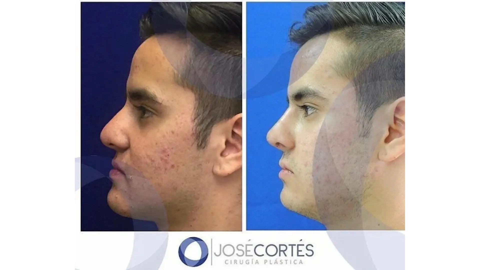 Rhinoplasty in Mexico City, Mexico by Jose Cortes Institute